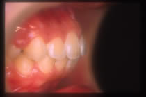 出っ歯（上顎前突）　施術後