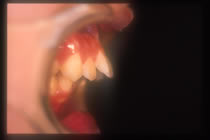 出っ歯（上顎前突）　施術前